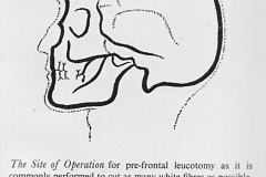 Luecotomy_Diagram